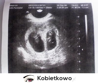 Ta surogatka zaszła w ciążę, podczas noszenia dziecka dla innej pary!