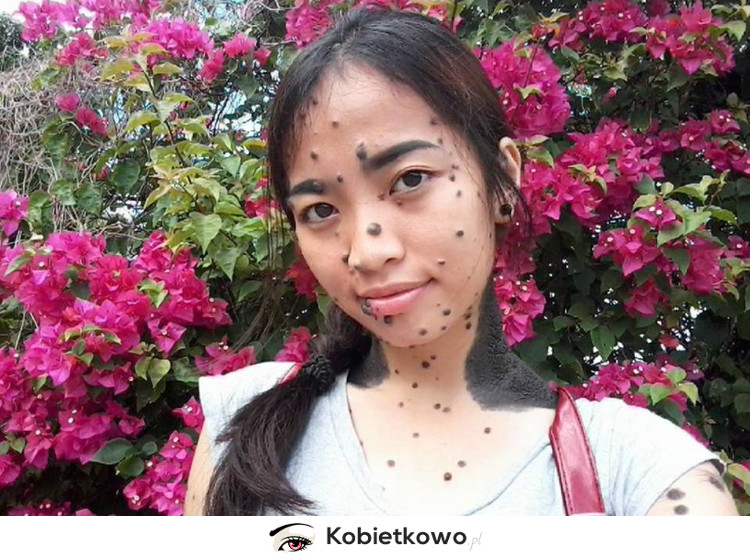 20-letnia Malezyjka całe ciało ma pokryte pieprzykami i znamionami!