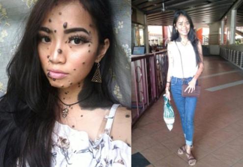 20-letnia Malezyjka całe ciało ma pokryte pieprzykami i znamionami!