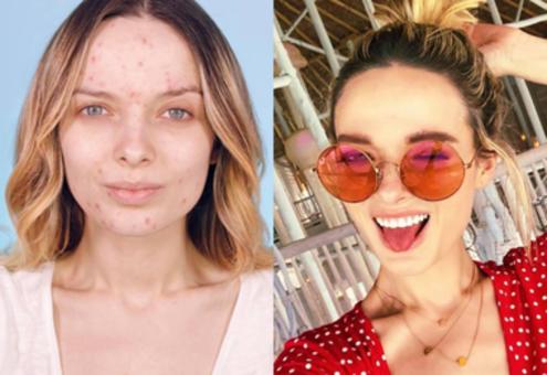 26 letnia blogerka  z trądzikiem robi karierę na Instagramie!